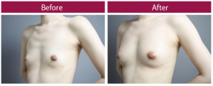 脂肪豊胸 デコルテ 症例写真