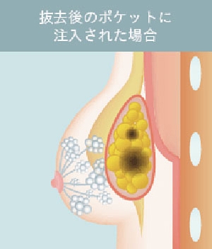 豊胸手術 脂肪注入 しこり