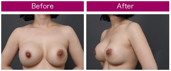 豊胸手術 シリコンバッグ 失敗