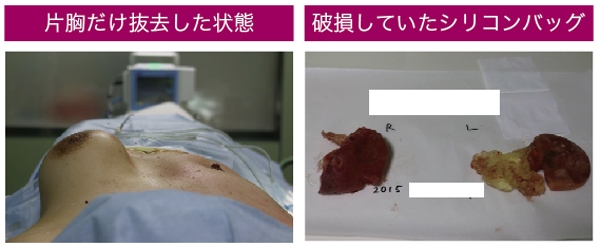 シリコンバッグ 破損 画像
