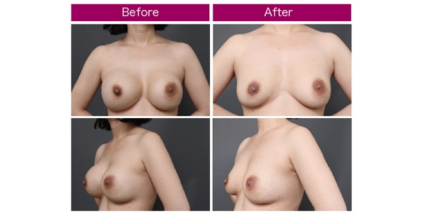 豊胸手術 シリコンバッグ 脂肪注入