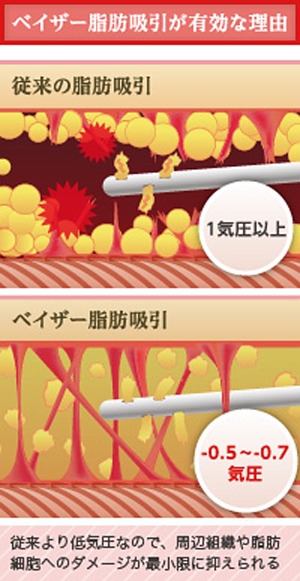 ベイザー脂肪吸引 脂肪注入