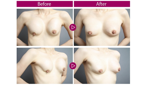 豊胸手術 シリコンバッグ 症例画像