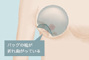 シリコンバッグ豊胸 リップリング 原因
