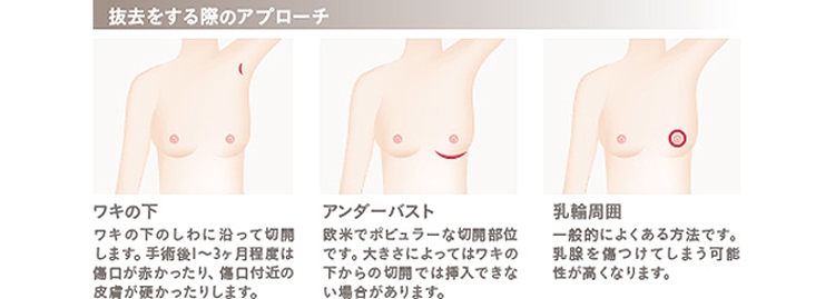 豊胸手術 バッグ抜去 位置