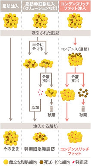 豊胸手術 脂肪注入 違い