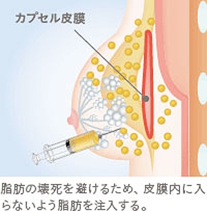 豊胸脂肪注入 しこり 防ぐ