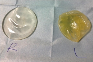 シリコン バッグ 抜去