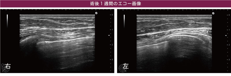 術後 エコー画像