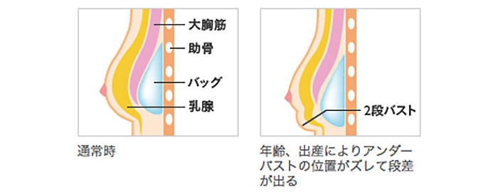 シリコンバッグ 豊胸 段差