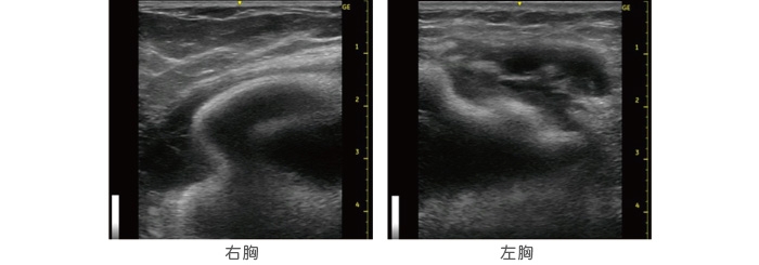 シリコンバッグ 破損 エコー画像