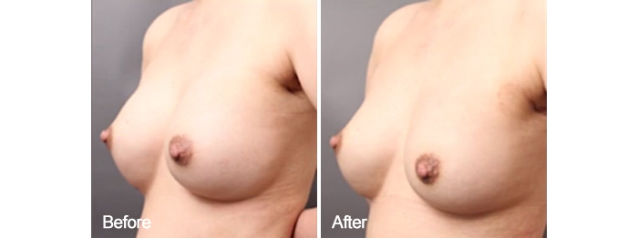 ハイブリット豊胸 症例