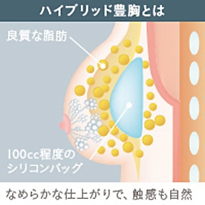 ハイブリット豊胸とは