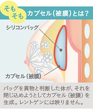 シリコンバッグ カプセル拘縮