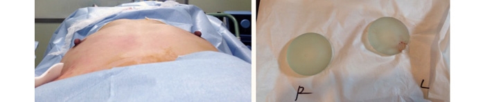 豊胸手術 失敗 画像 症例