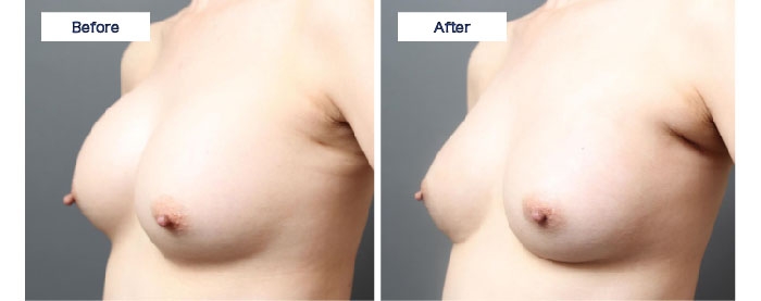 シリコンバッグ 破損 不自然