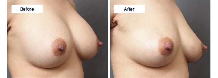 豊胸バッグ コンデンスリッチ豊胸 バストライン