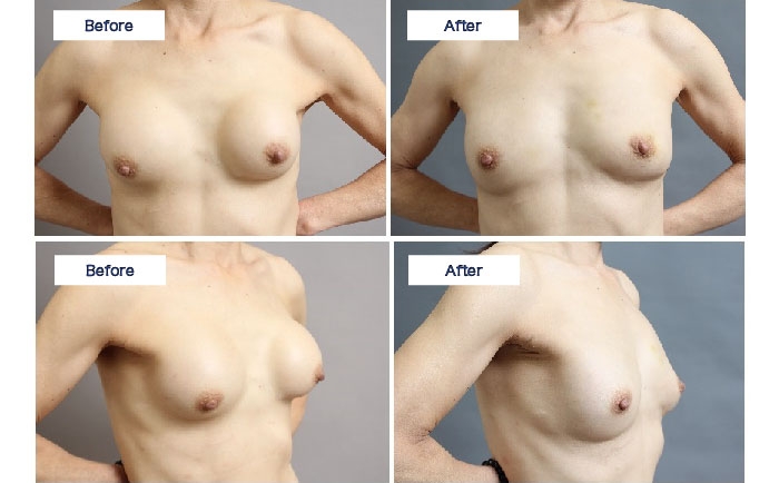 シリコンバッグ カプセル拘縮 破損