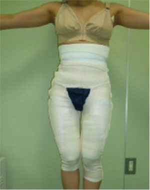 コンデンスリッチ豊胸 術後 ダウンタイム