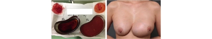 シリコンバッグ 破損 腫れ