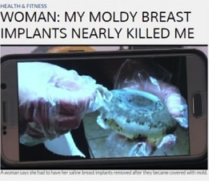 豊胸バッグ 劣化 破損