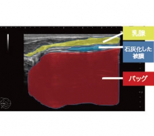 シリコンバッグ 豊胸 エコー