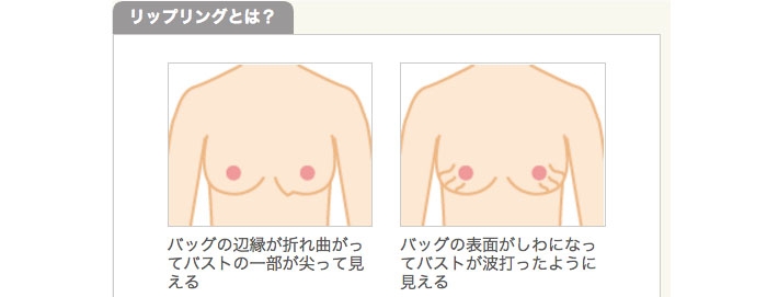 リップリングとは