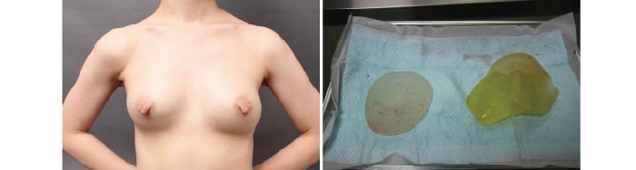 豊胸シリコンバッグの破損画像