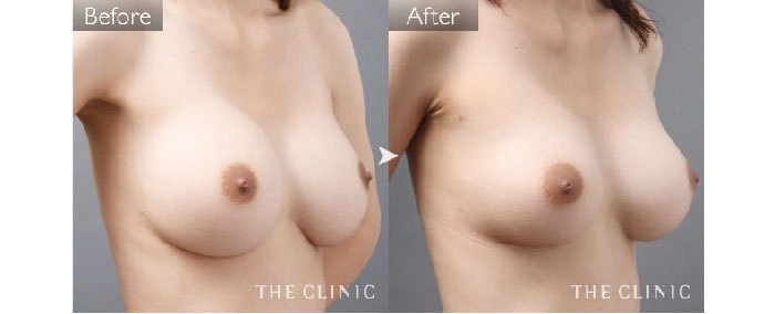 豊胸シリコンバッグ除去後の脂肪注入豊胸の症例