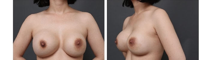 豊胸インプラントが挿入されたバスト