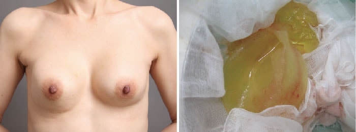 豊胸シリコンバッグから10年の胸