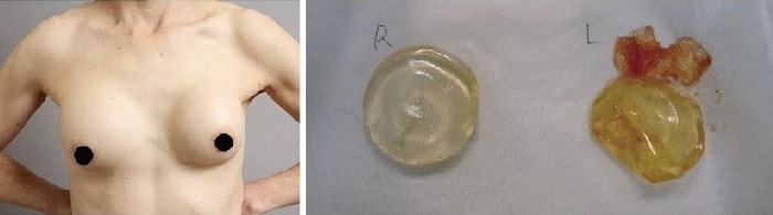 豊胸シリコンバッグから6年の胸