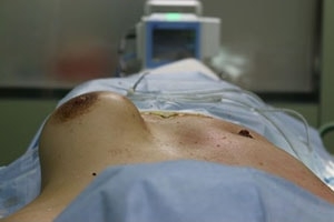 275ccの豊胸バッグを除去した症例