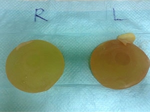 除去した豊胸シリコンバッグ