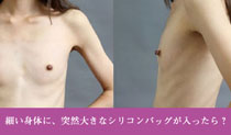 シリコンバッグ豊胸を痩せ型の人が行った場合の2大問題 イメージ画像