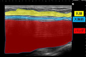 豊胸カウンセリング