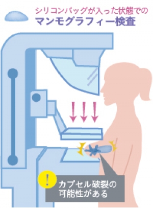 乳がん検査 豊胸