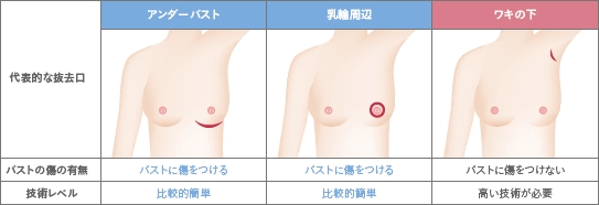 シリコンバッグ摘出 場所