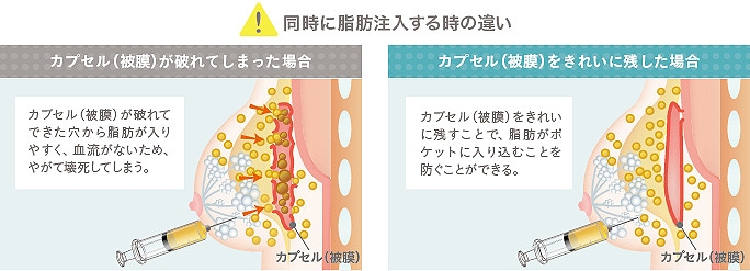 シリコンバッグ抜去 脂肪注入