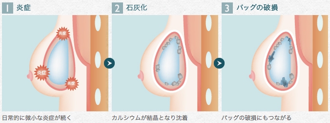 シリコンバッグ 石灰化 原因
