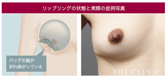 シリコンバッグ リップリング