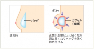 シリコンバッグ 不自然