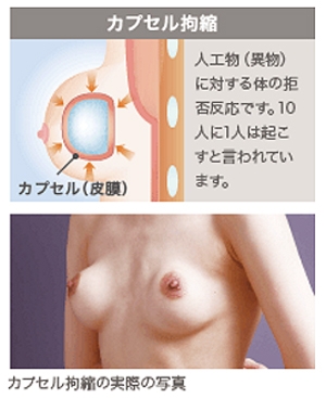 シリコンバッグ豊胸 カプセル拘縮