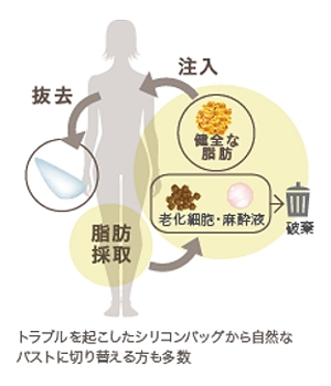 豊胸 バッグ抜去 脂肪注入