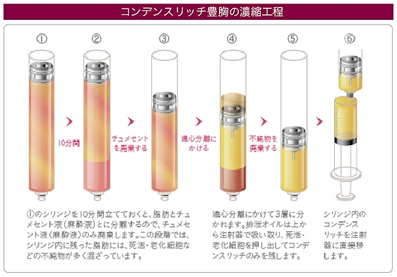 コンデンスリッチ豊胸 濃縮