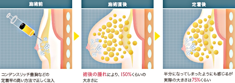 コンデンスリッチ豊胸
