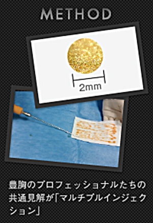 脂肪注入 コンデンスリッチ