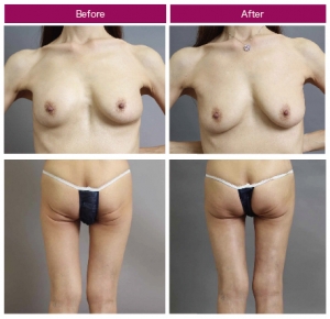 バッグ抜去 脂肪豊胸 痩せ型