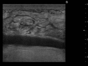 豊胸手術 シリコンバッグ 抜去
