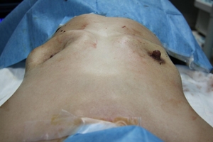 豊胸手術 シリコンバッグ抜去 症例画像